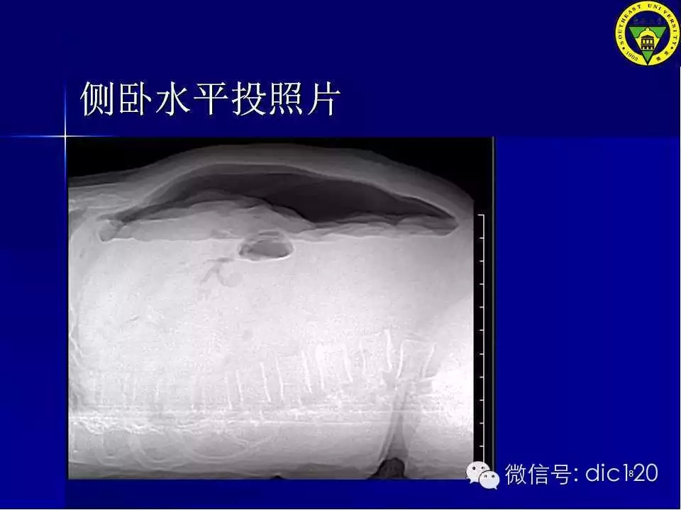 急腹症的影像学诊断