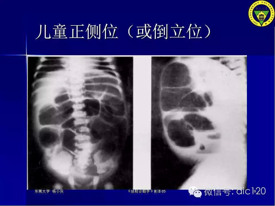急腹症的影像学诊断