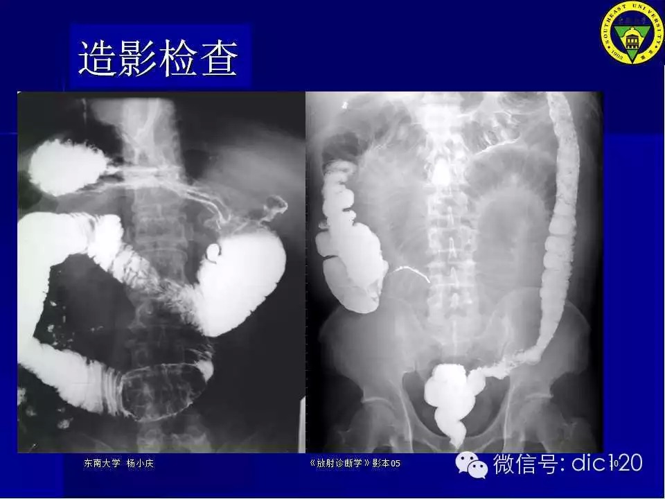 急腹症的影像学诊断