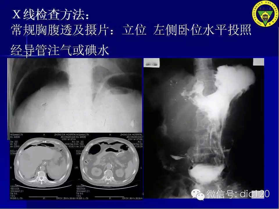 急腹症的影像学诊断