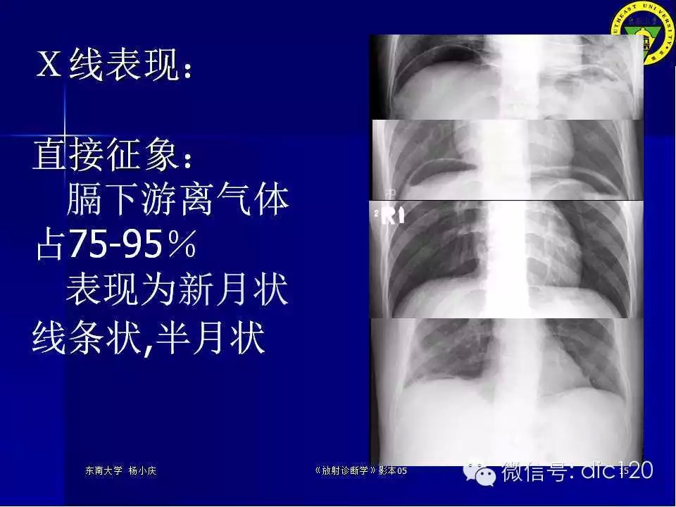 急腹症的影像学诊断