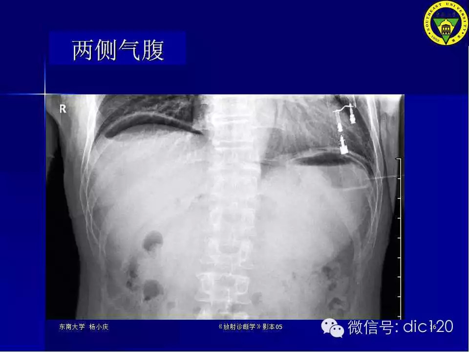 急腹症的影像学诊断