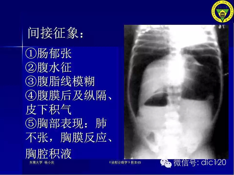 急腹症的影像学诊断