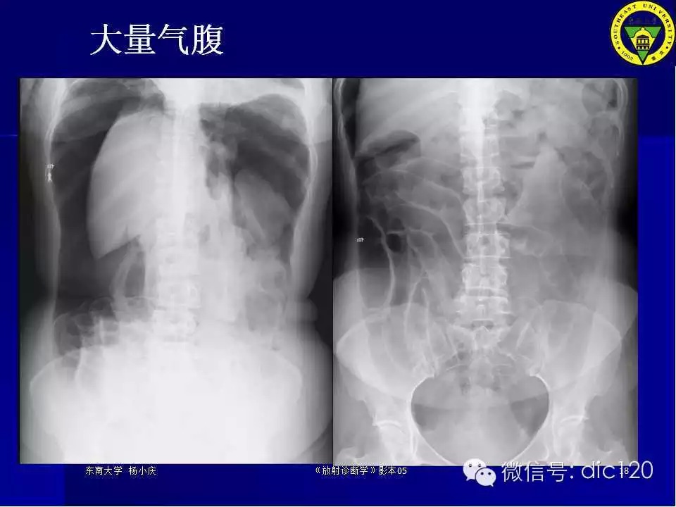 急腹症的影像学诊断