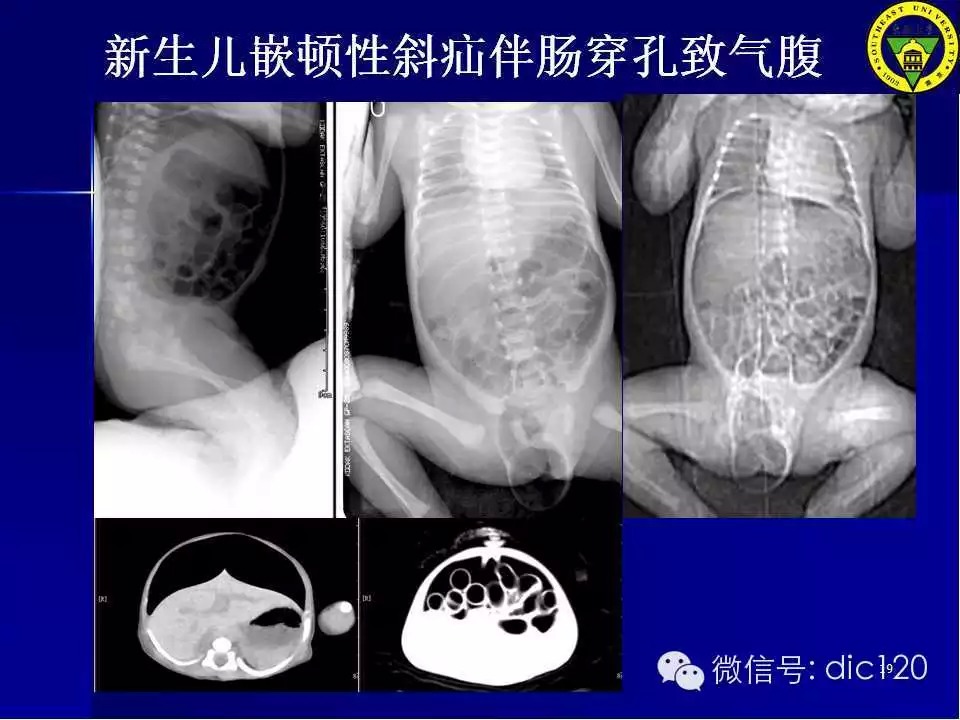 急腹症的影像学诊断