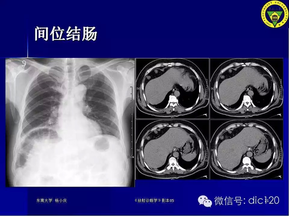 急腹症的影像学诊断