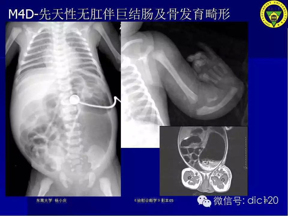 急腹症的影像学诊断
