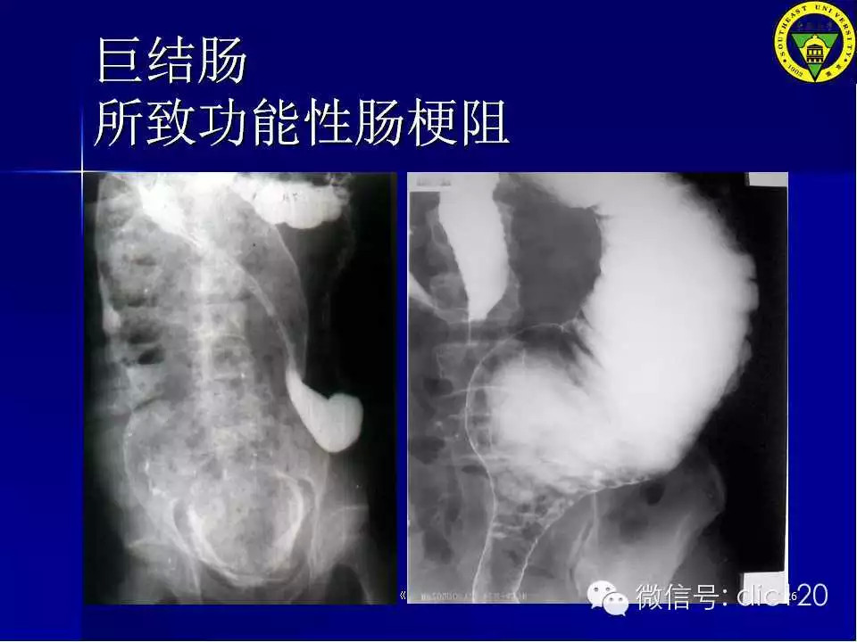 急腹症的影像学诊断