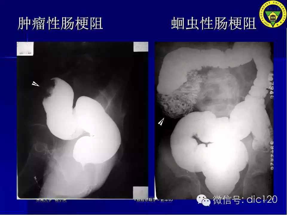 急腹症的影像学诊断