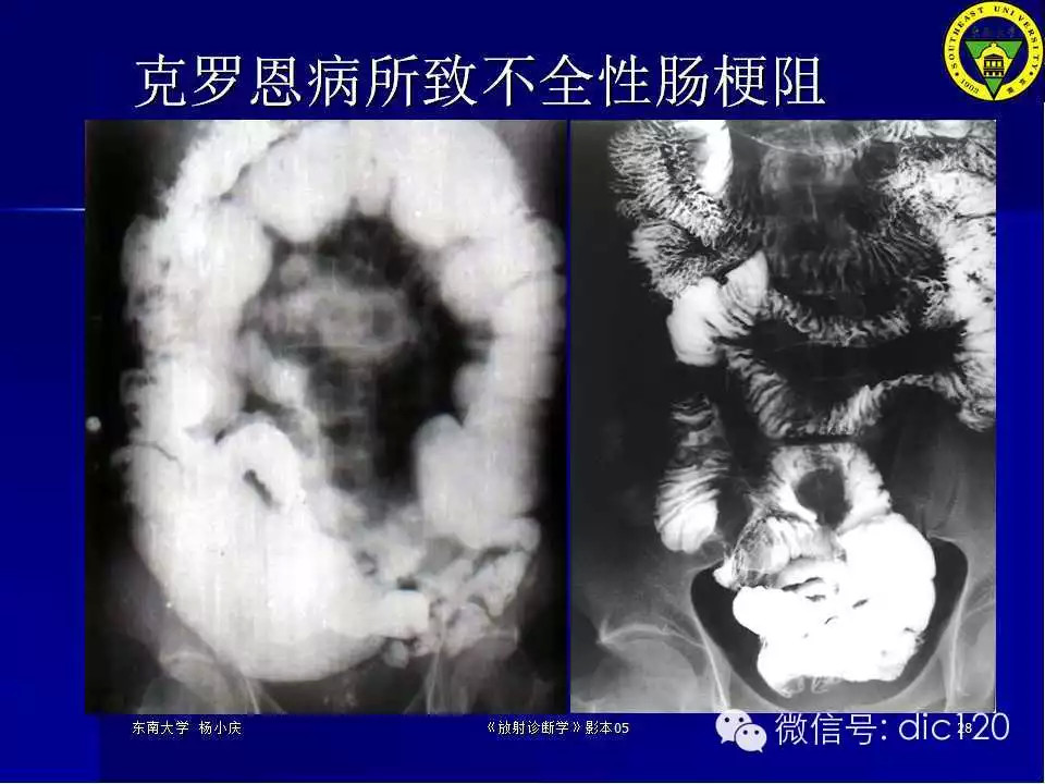 急腹症的影像学诊断