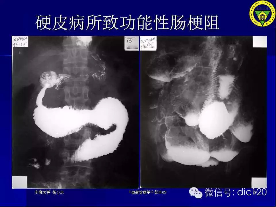 急腹症的影像学诊断