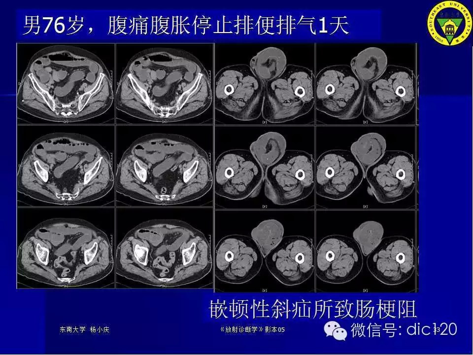 急腹症的影像学诊断