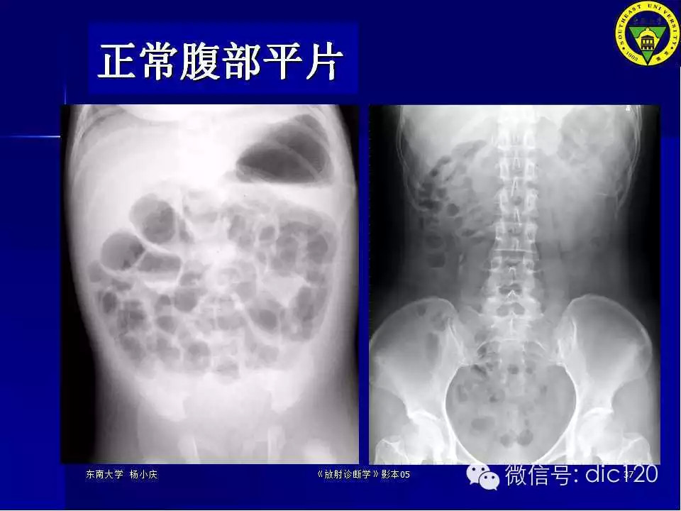 急腹症的影像学诊断