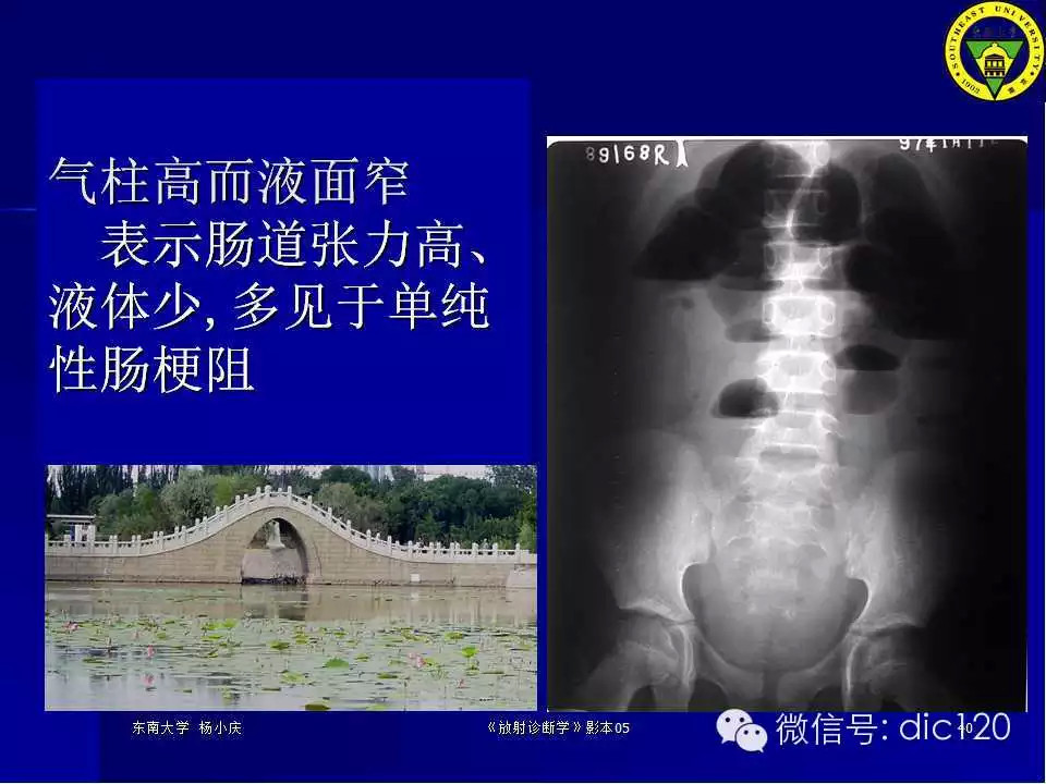急腹症的影像学诊断