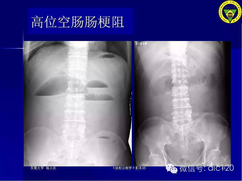 急腹症的影像学诊断