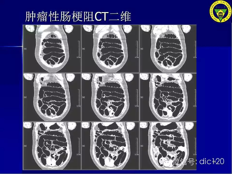 急腹症的影像学诊断