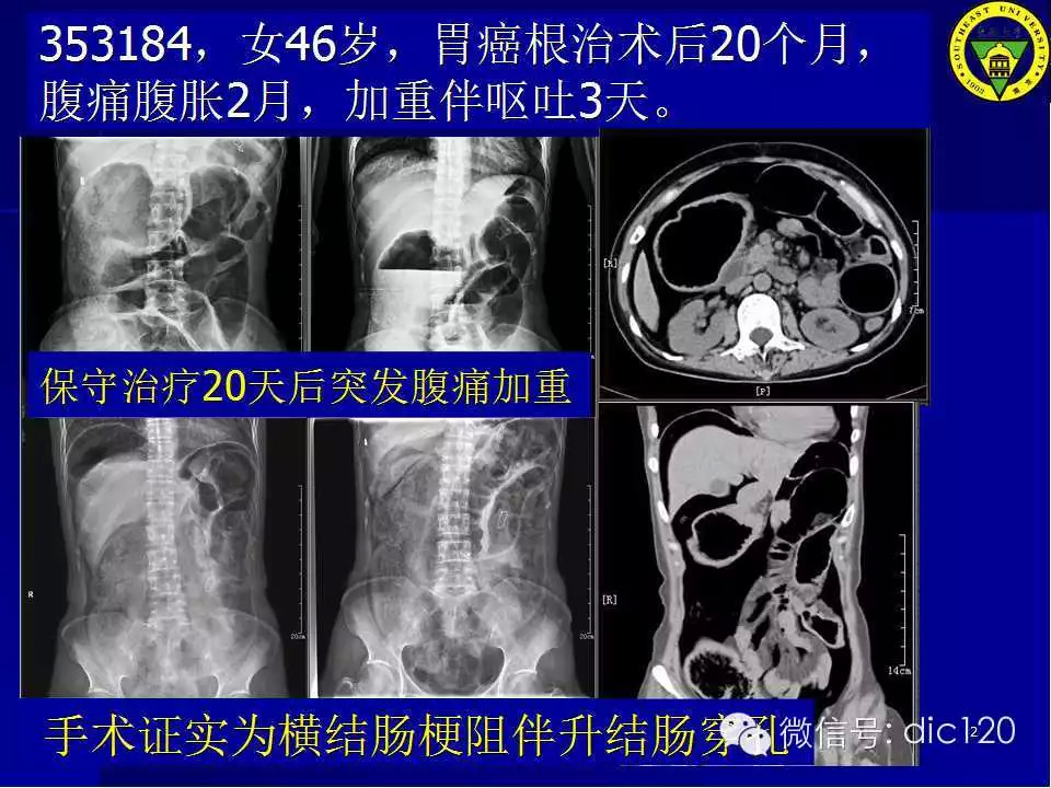 急腹症的影像学诊断