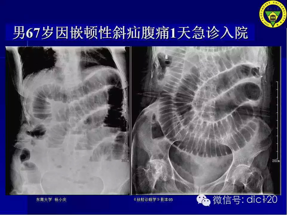 急腹症的影像学诊断