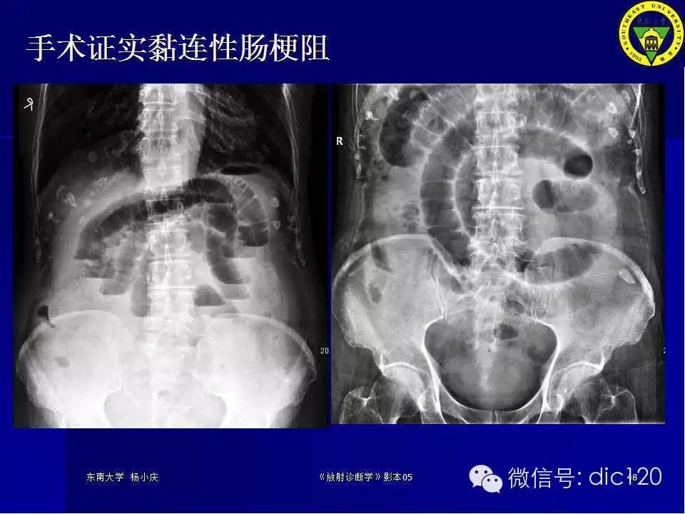 急腹症的影像学诊断