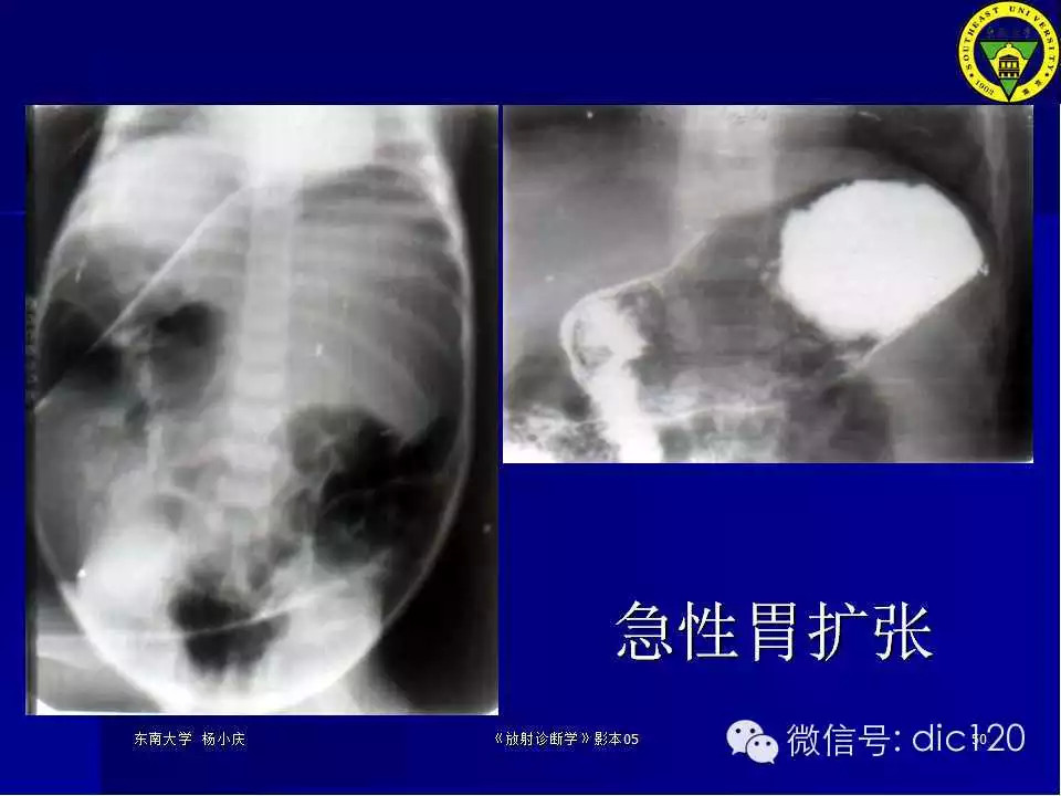 急腹症的影像学诊断