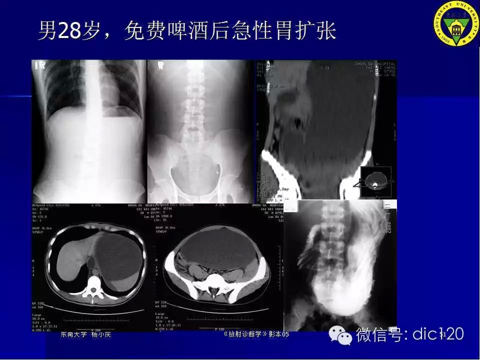 急腹症的影像学诊断