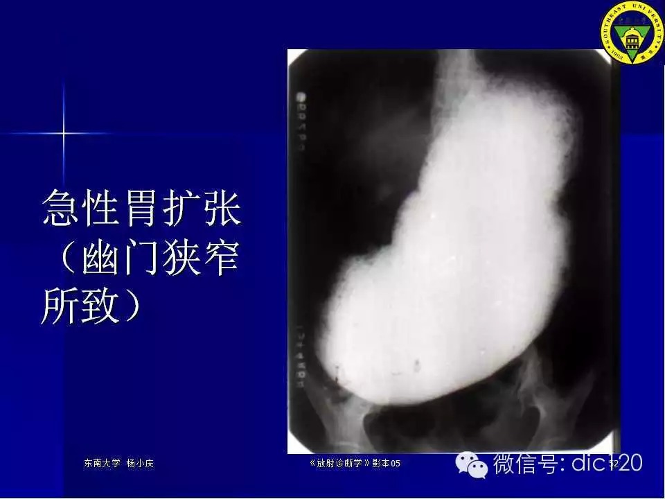 急腹症的影像学诊断
