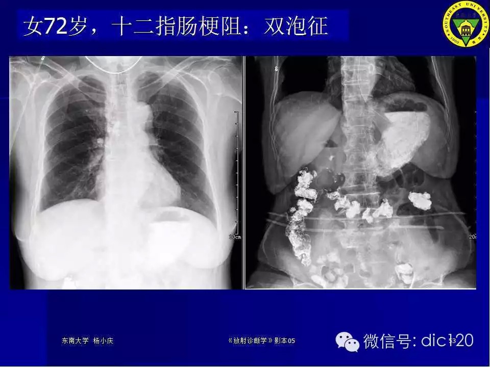 急腹症的影像学诊断