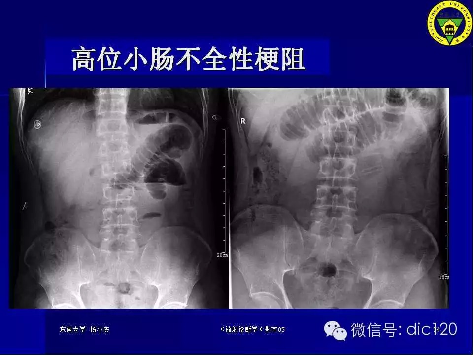急腹症的影像学诊断