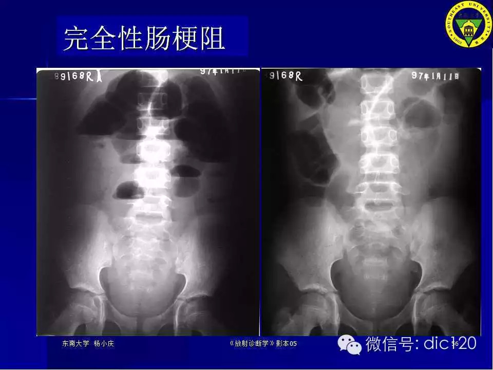 急腹症的影像学诊断