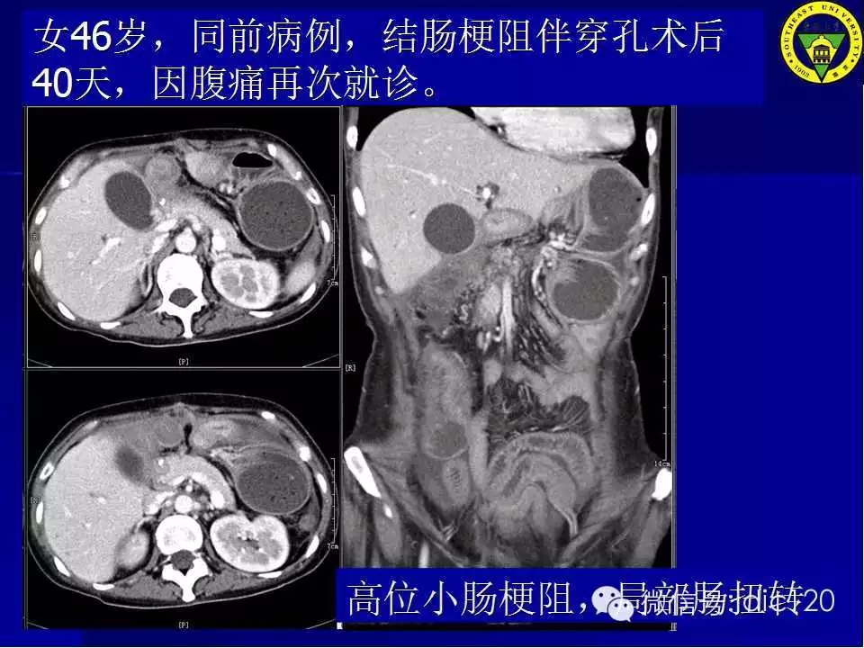 急腹症的影像学诊断