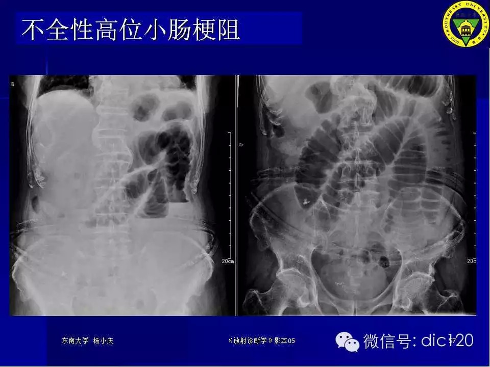 急腹症的影像学诊断