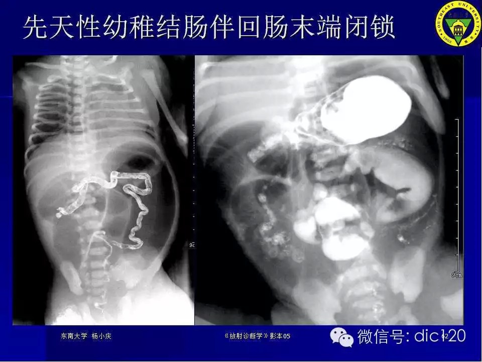 急腹症的影像学诊断