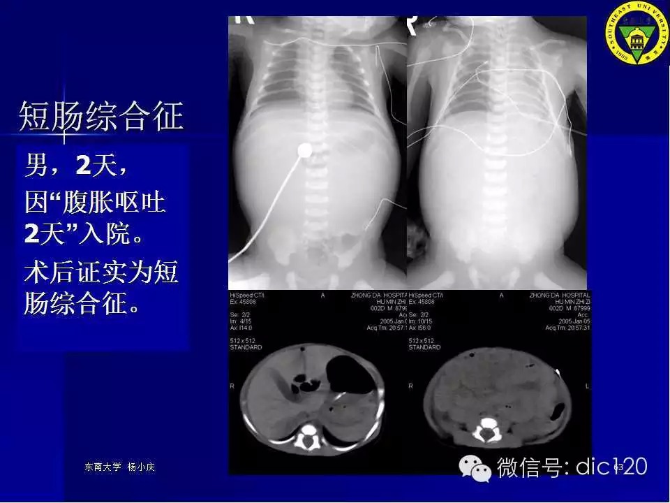 急腹症的影像学诊断