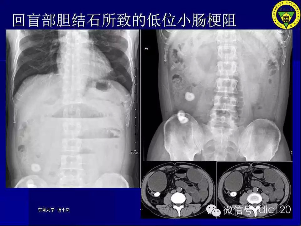 急腹症的影像学诊断