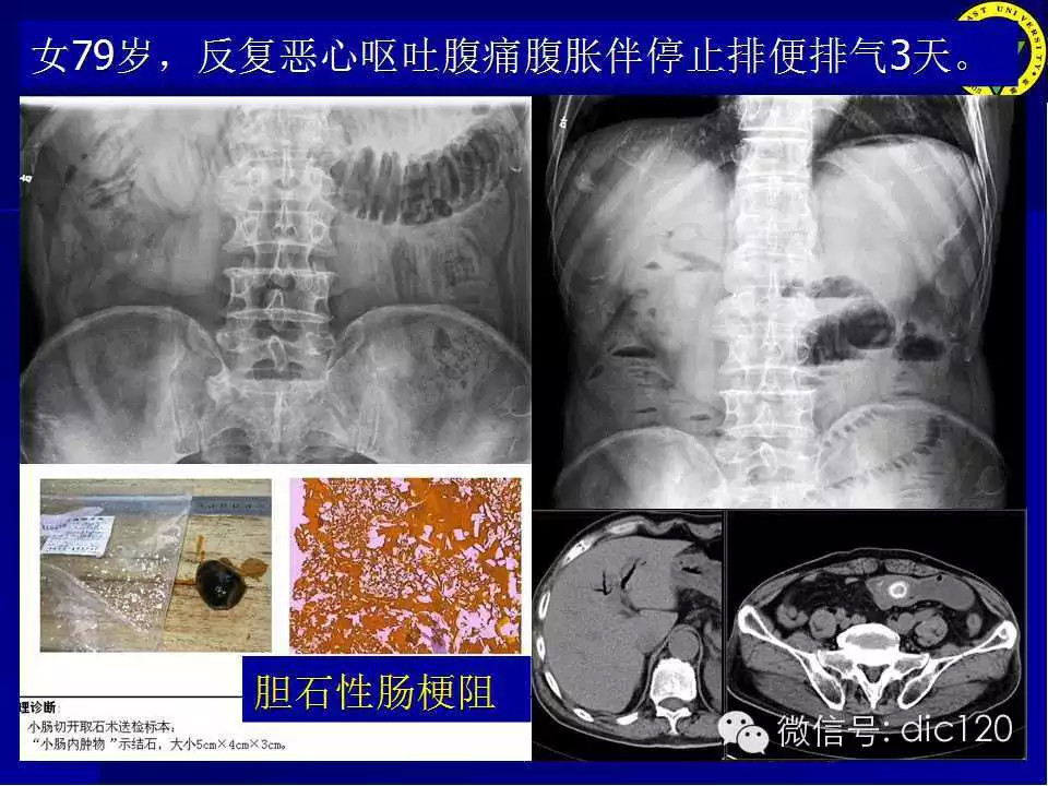 急腹症的影像学诊断