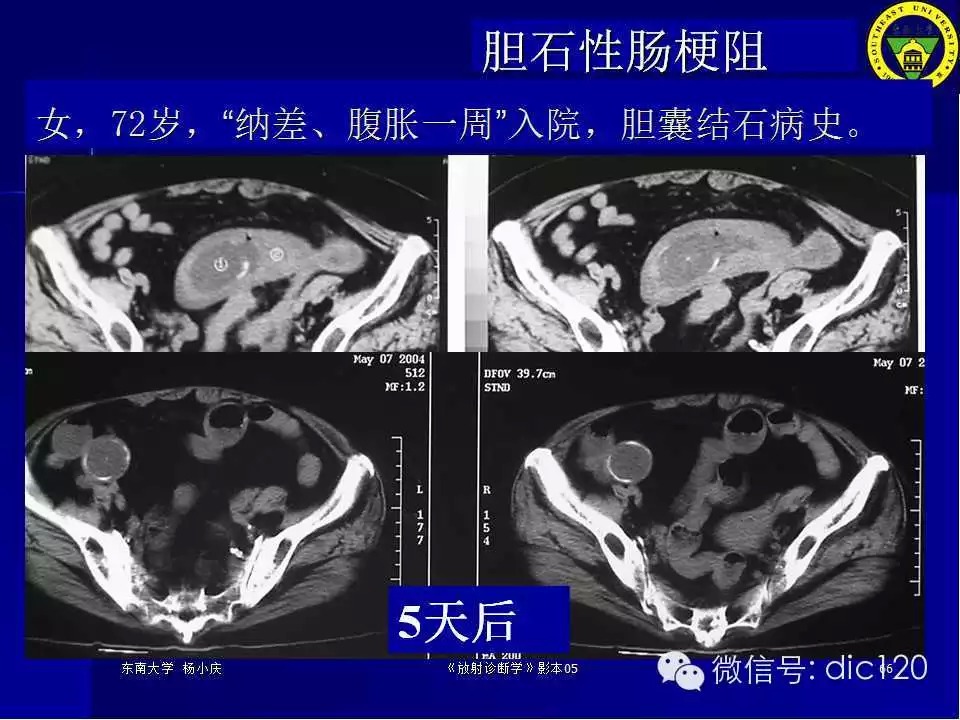 急腹症的影像学诊断