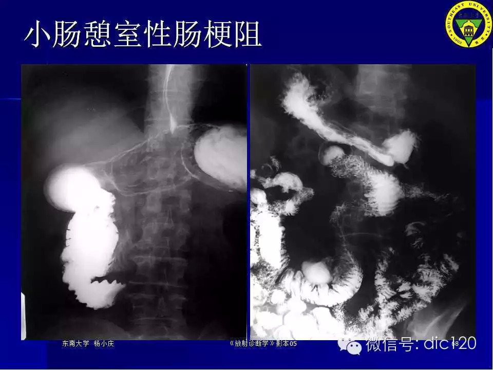 急腹症的影像学诊断
