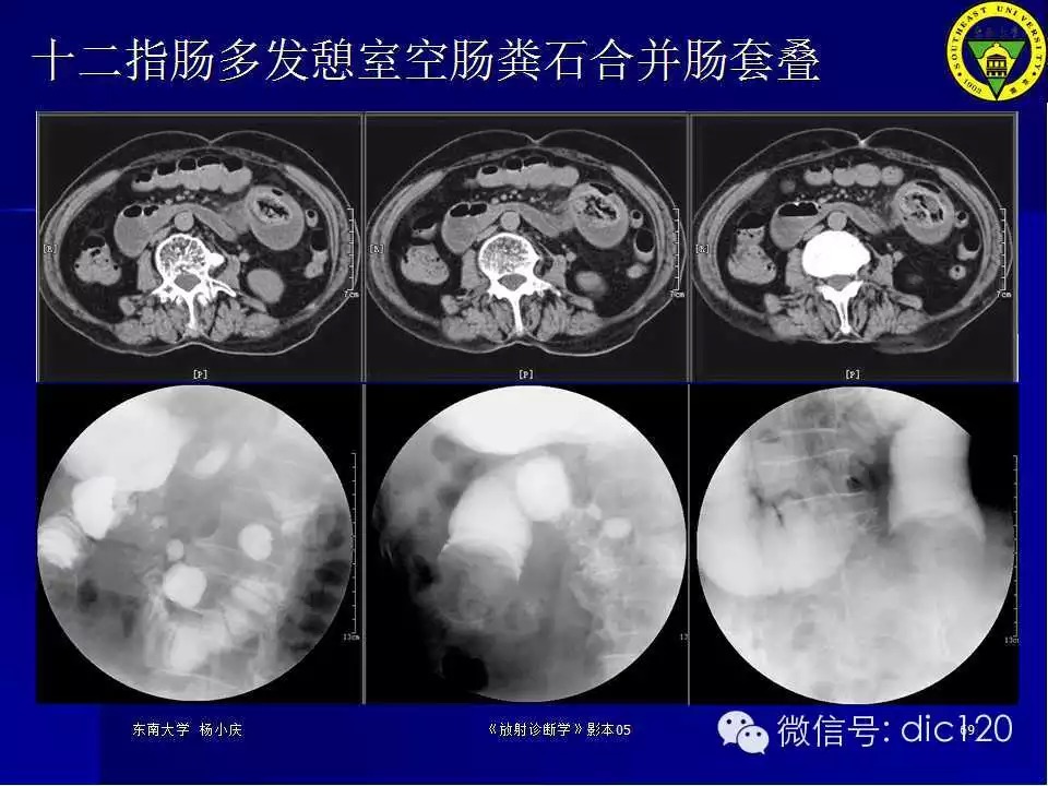 急腹症的影像学诊断