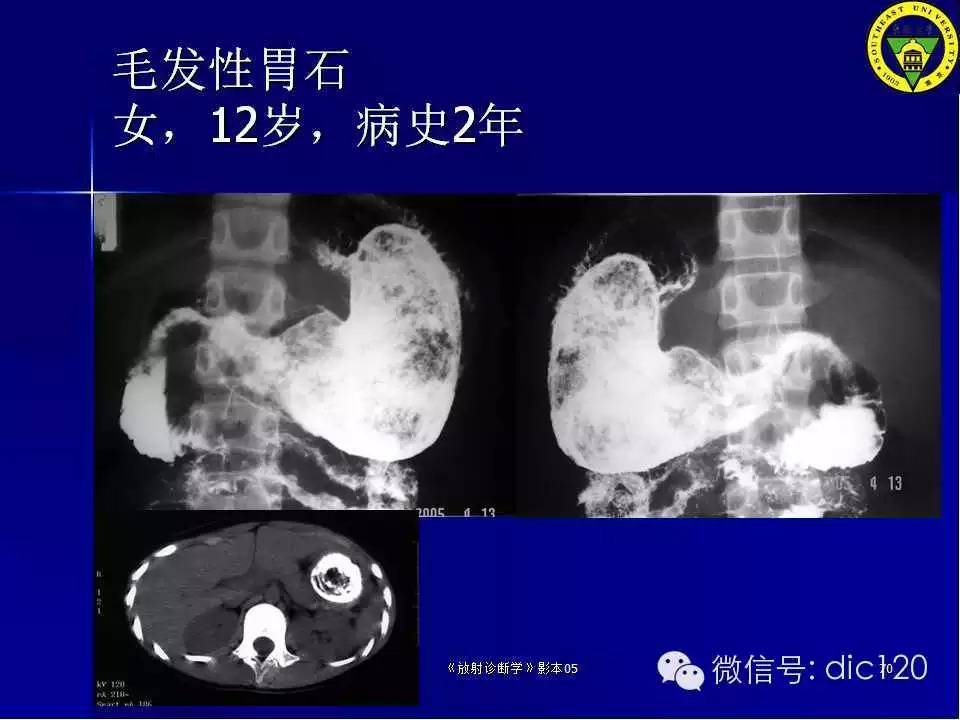 急腹症的影像学诊断