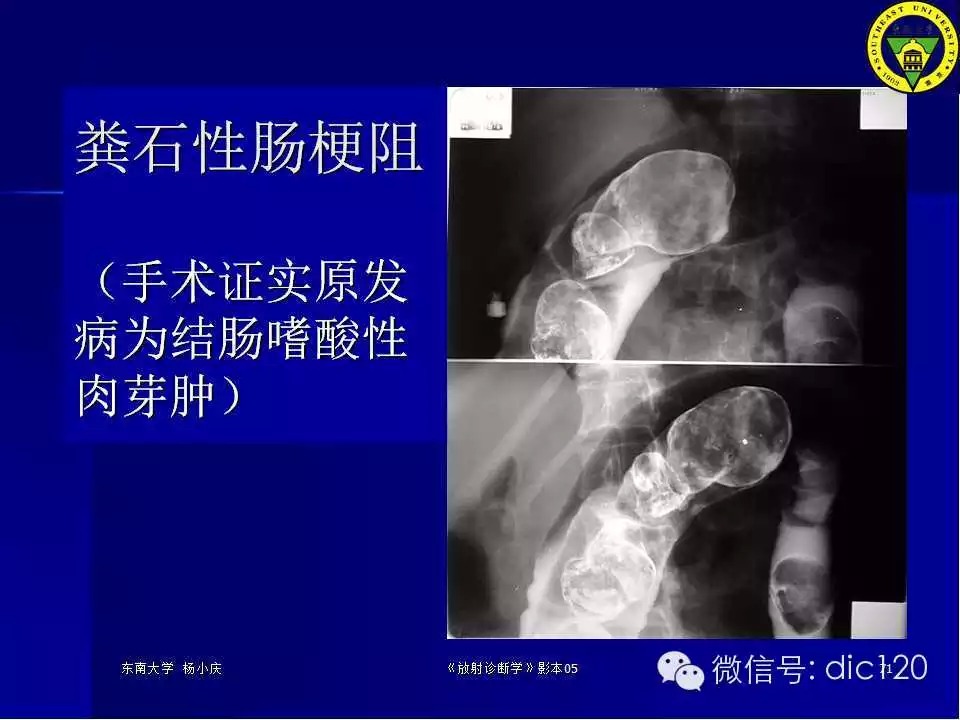 急腹症的影像学诊断
