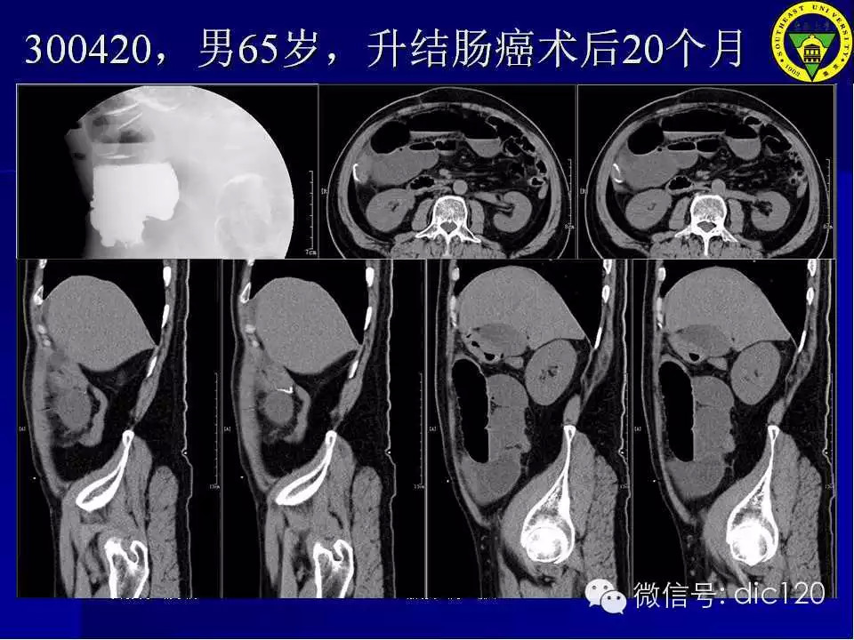 急腹症的影像学诊断