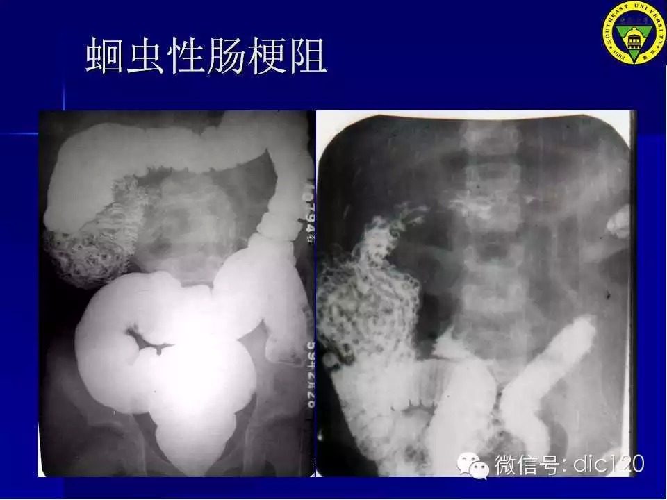 急腹症的影像学诊断
