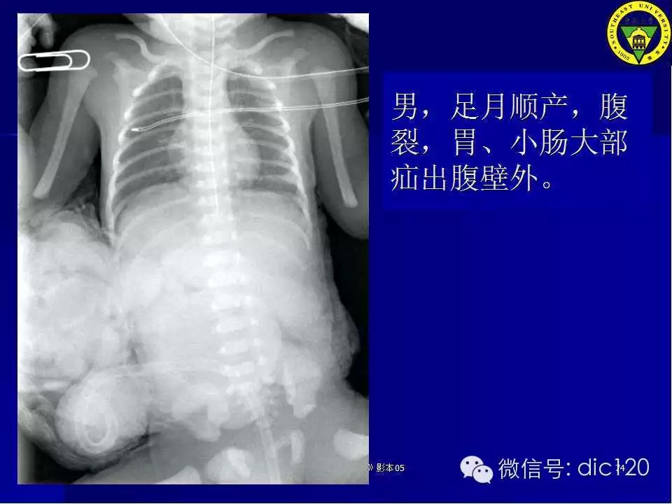 急腹症的影像学诊断
