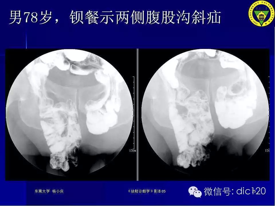 急腹症的影像学诊断