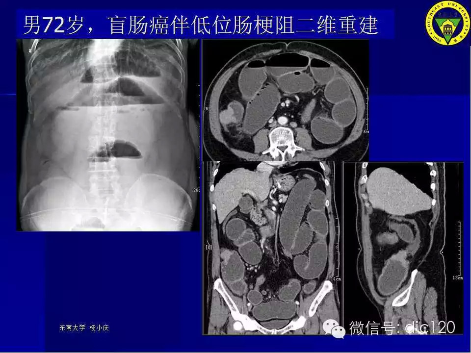 急腹症的影像学诊断