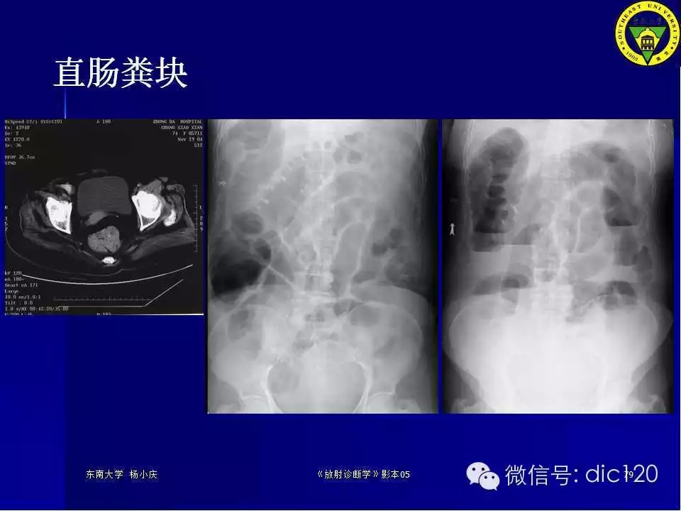 急腹症的影像学诊断