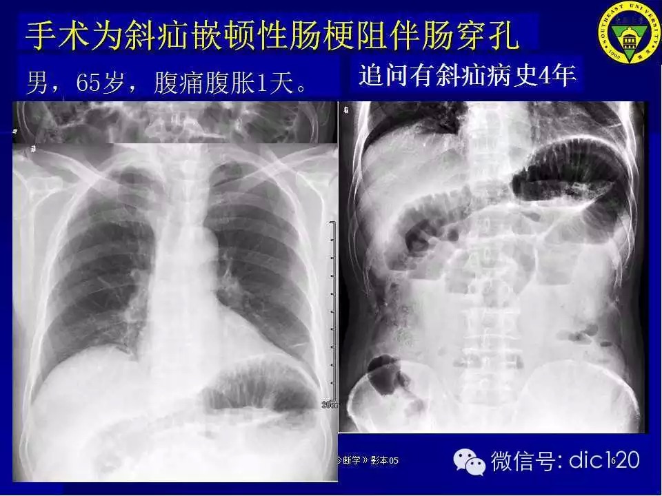 急腹症的影像学诊断