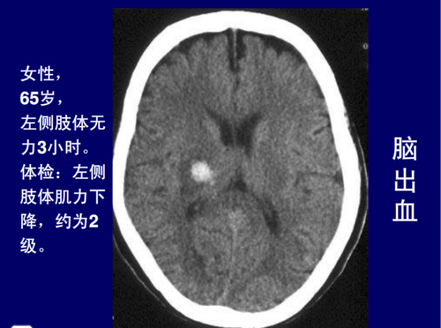 脑血管的影像解剖