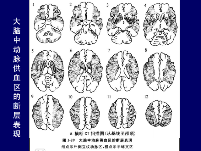 脑血管的影像解剖