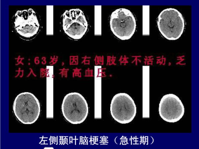脑血管的影像解剖